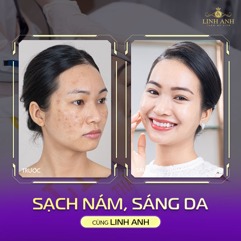 Trị nám thành công tại Linh Anh