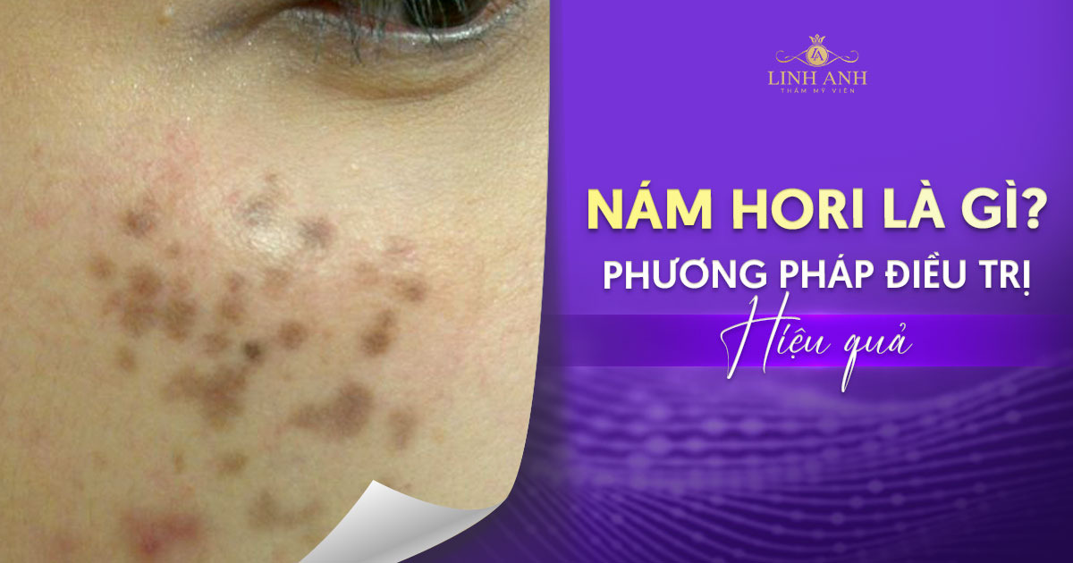 Nám hori là gì? Điều trị thế nào cho hiệu quả, da sáng mịn?