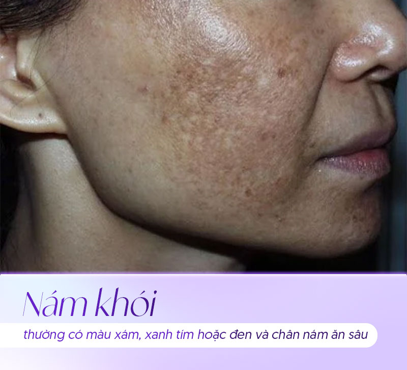 nhận biết nám khói