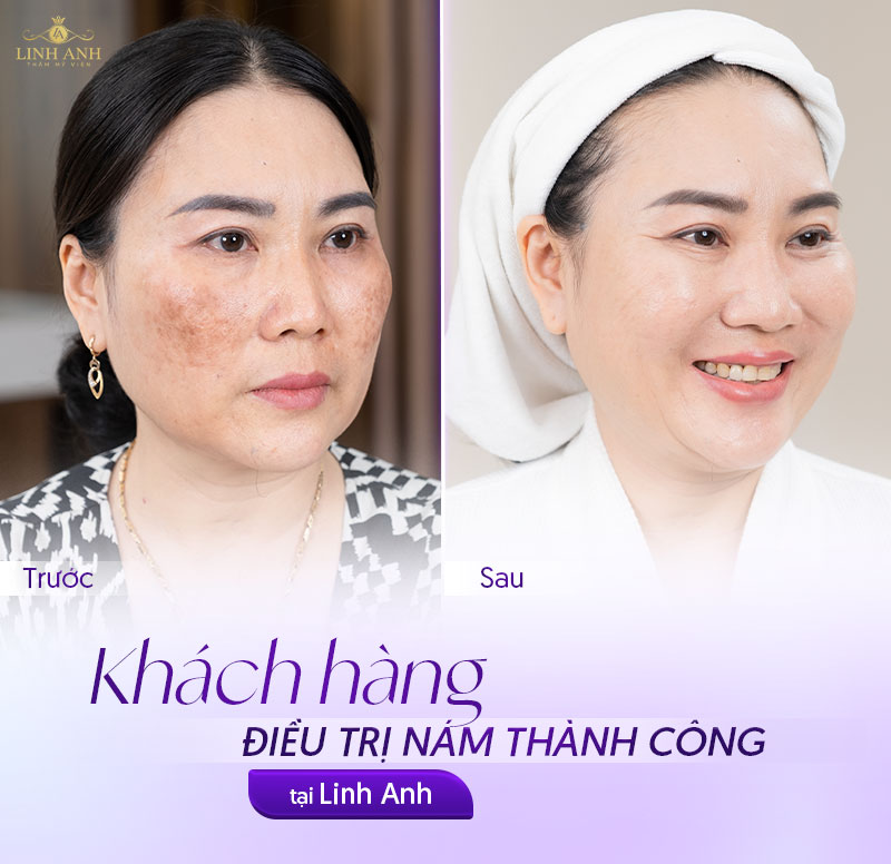trị nám khói thành công