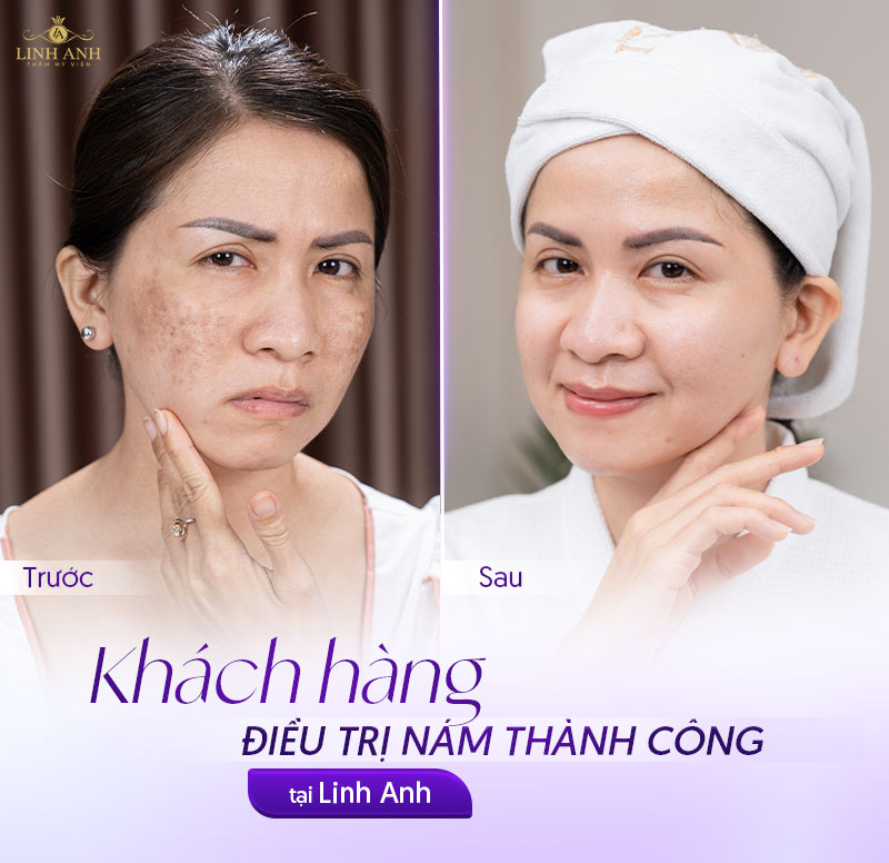 điều trị nám thành công