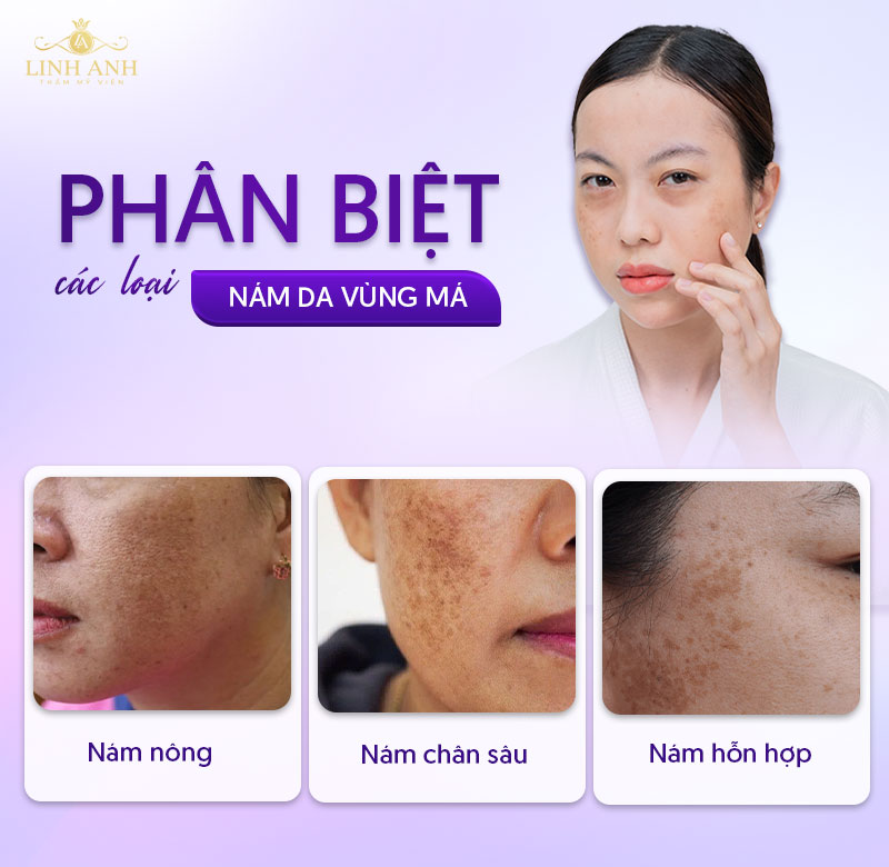 phân biệt các loại nám má