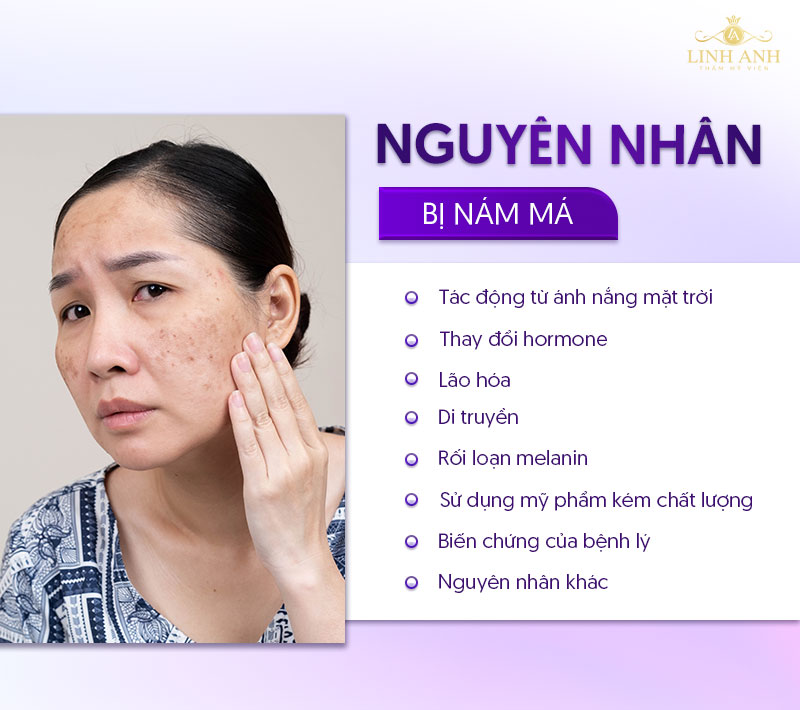 nguyên nhân da mặt bị nám