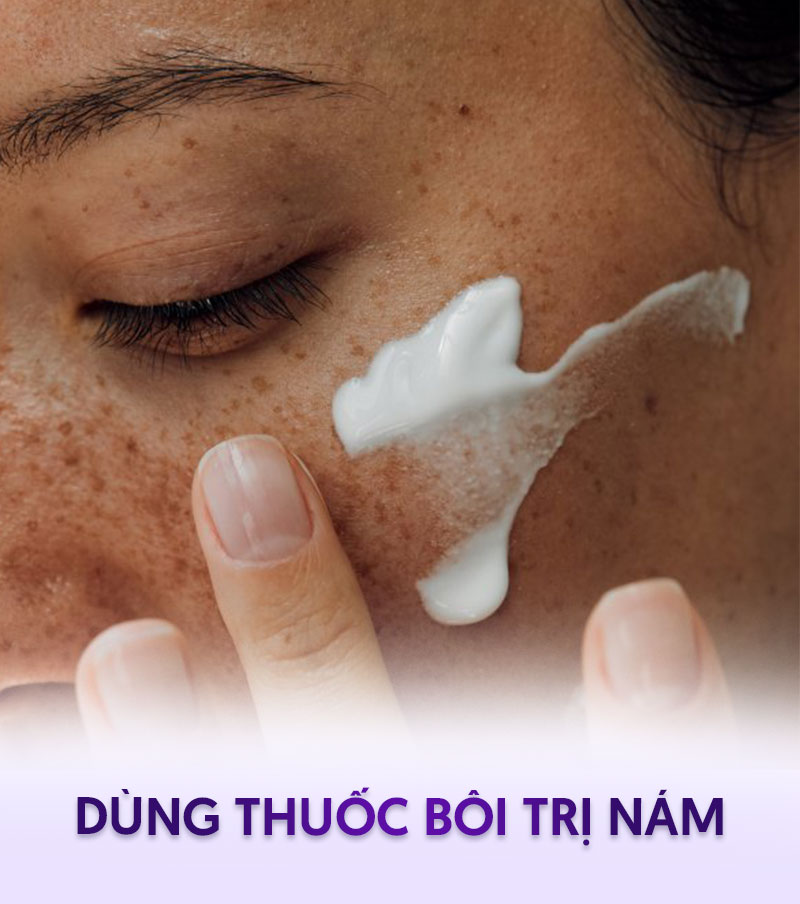 dùng thuốc bôi trị nám má