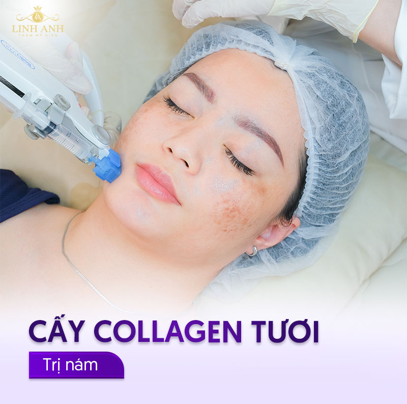 trị nám má bằng cách cấy collagen tươi