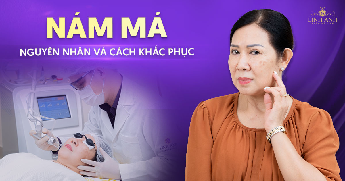 Nguyên nhân bị nám má và cách khắc phục, ngăn ngừa hiệu quả