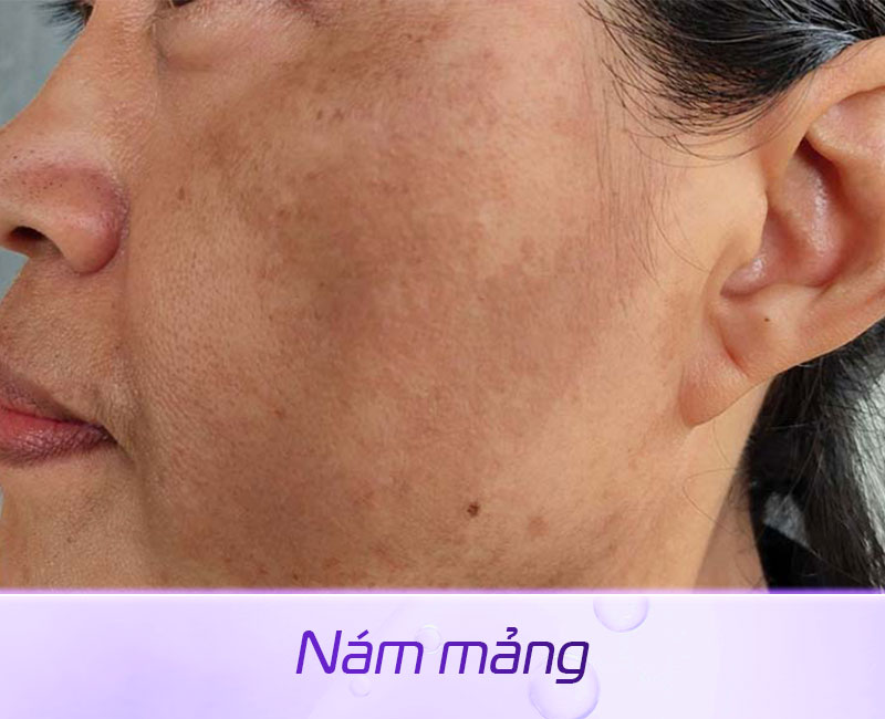 Nám mảng là gì