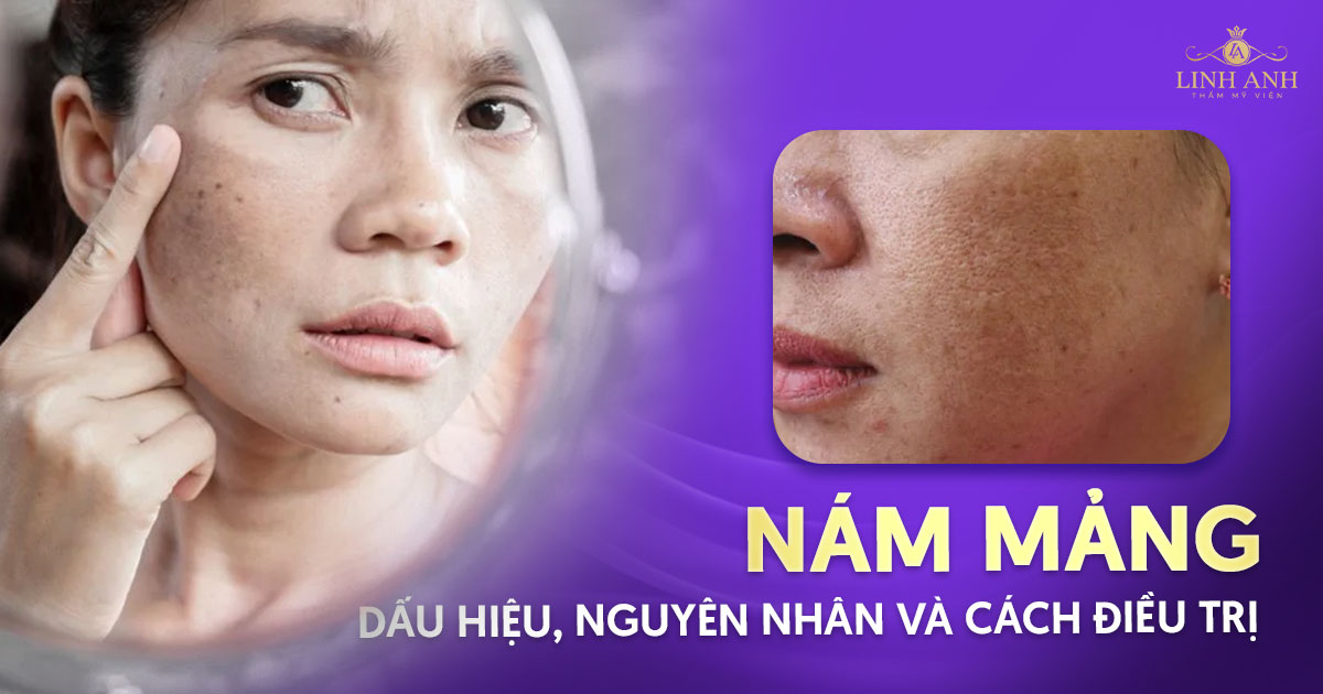 Nám mảng là gì? Dấu hiệu, nguyên nhân và cách điều trị