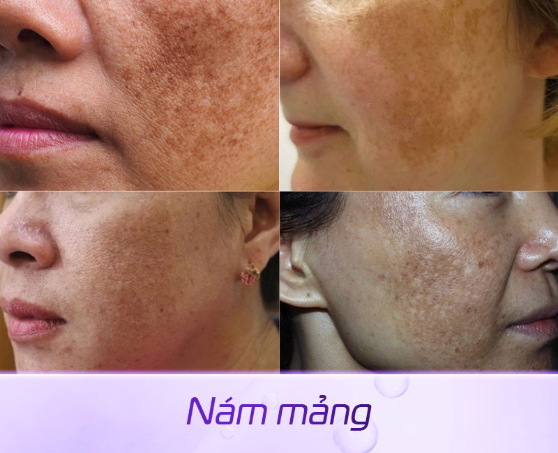 Hình ảnh nám mảng