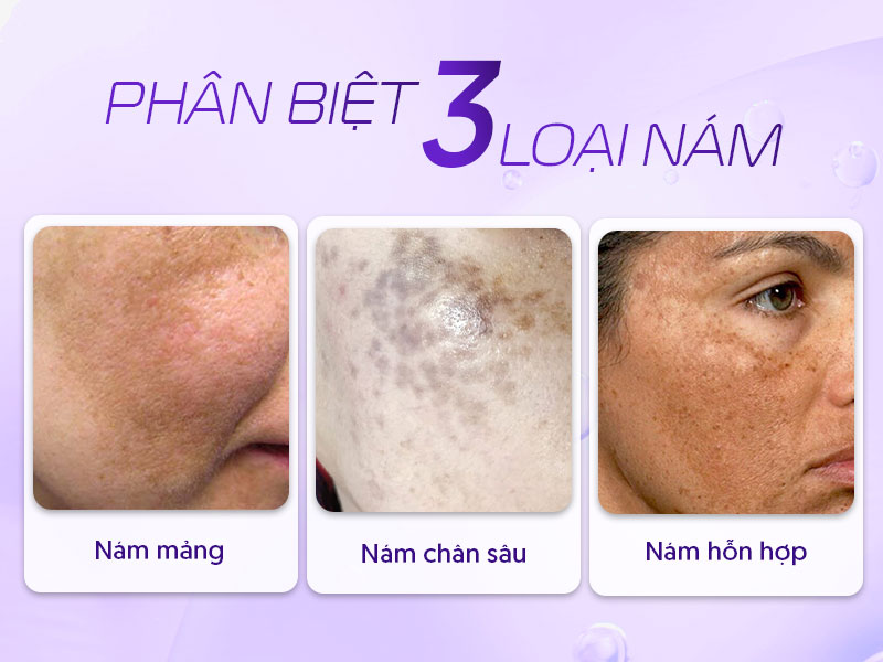 Các loại nám