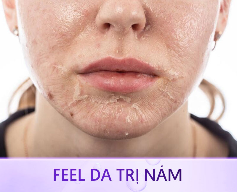 Peel da điều trị nám mảng