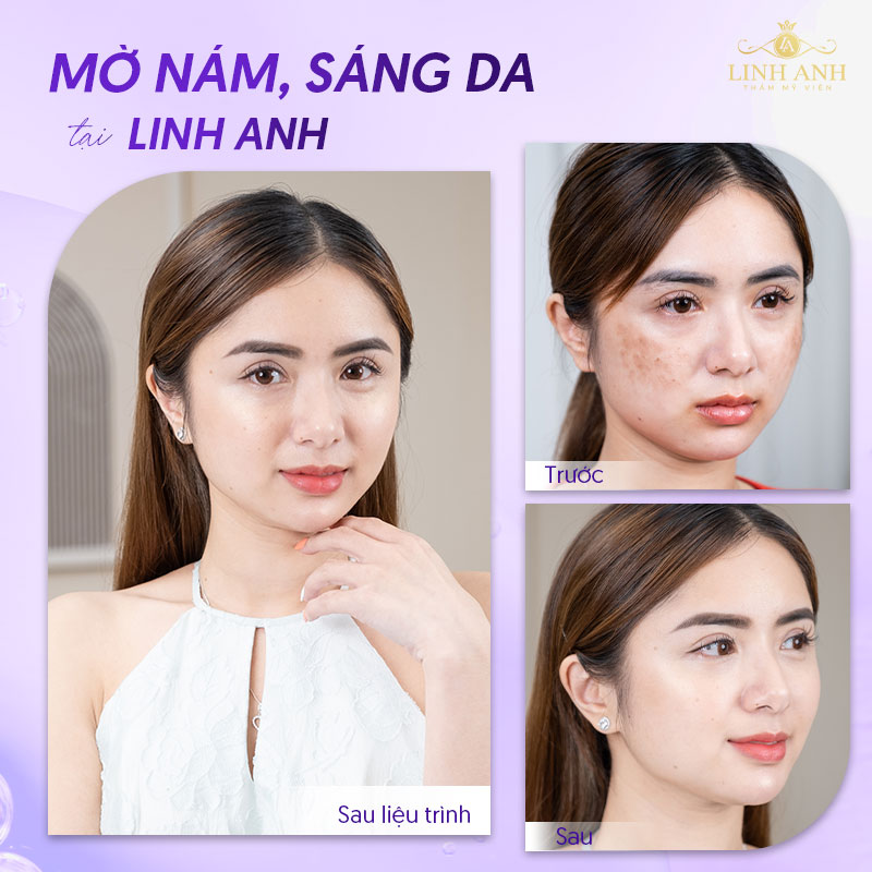 Điều trị nám mảng tại Linh Anh