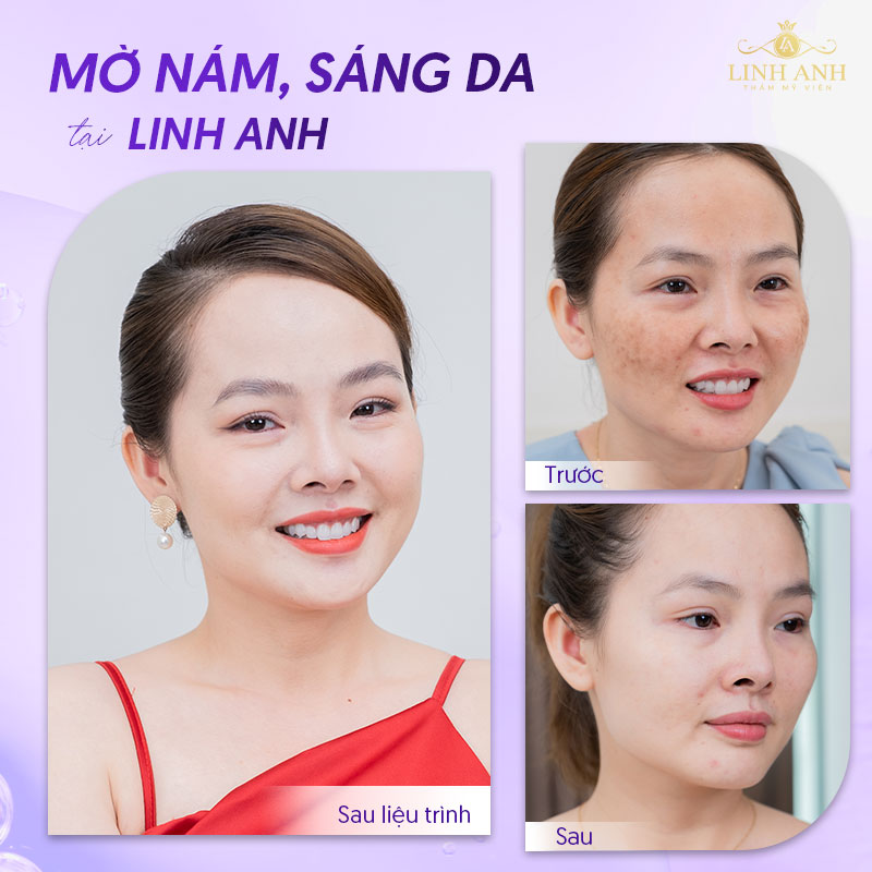 Trị nám mảng thành công tại Linh Anh