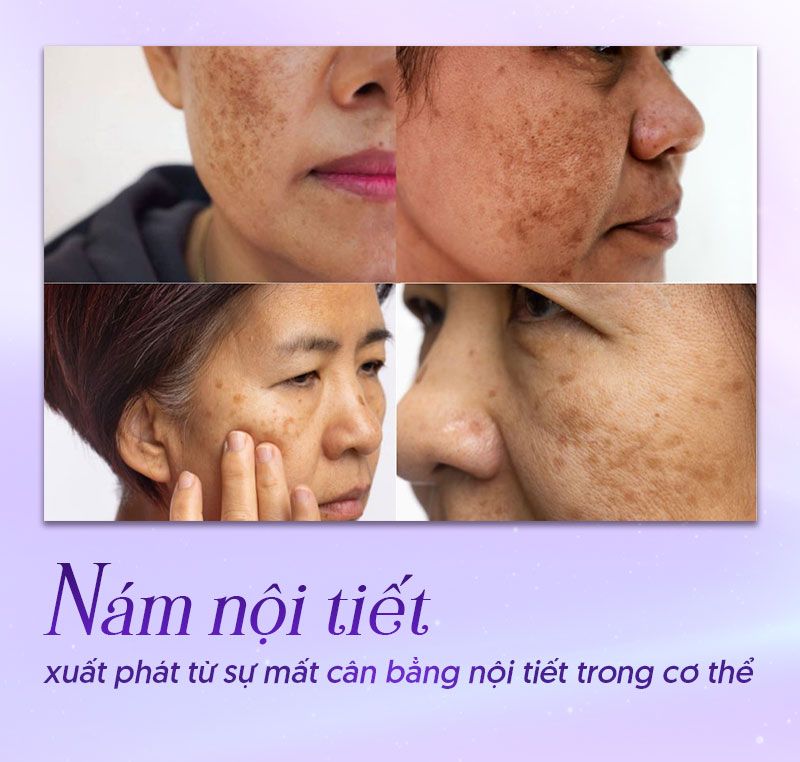 Nám nội tiết là gì