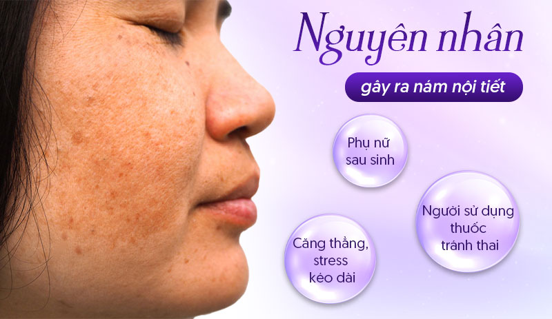 Nguyên nhân gây nám nội tiết