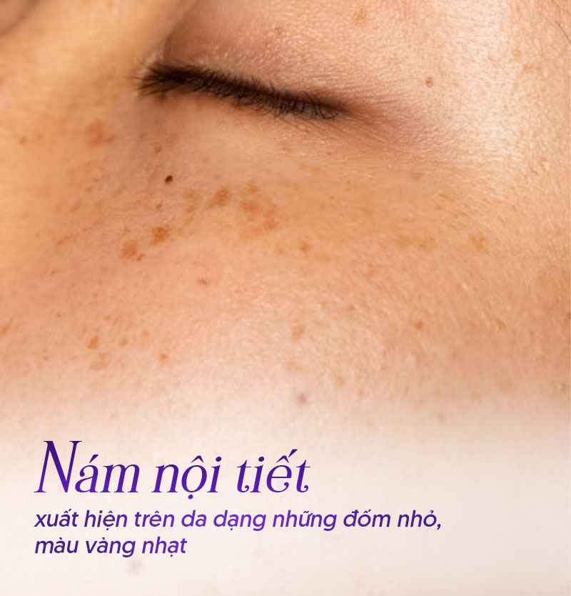 Hình ảnh nám nội tiết