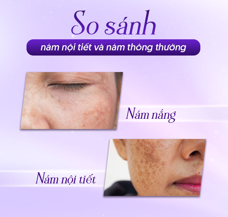 Phân biệt nám do nội tiết tố với nám thường