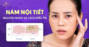 Nám nội tiết
