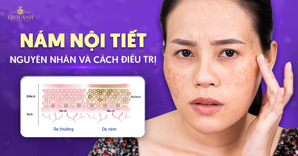 Nám nội tiết: Nguyên nhân, biểu hiện và phương pháp điều trị