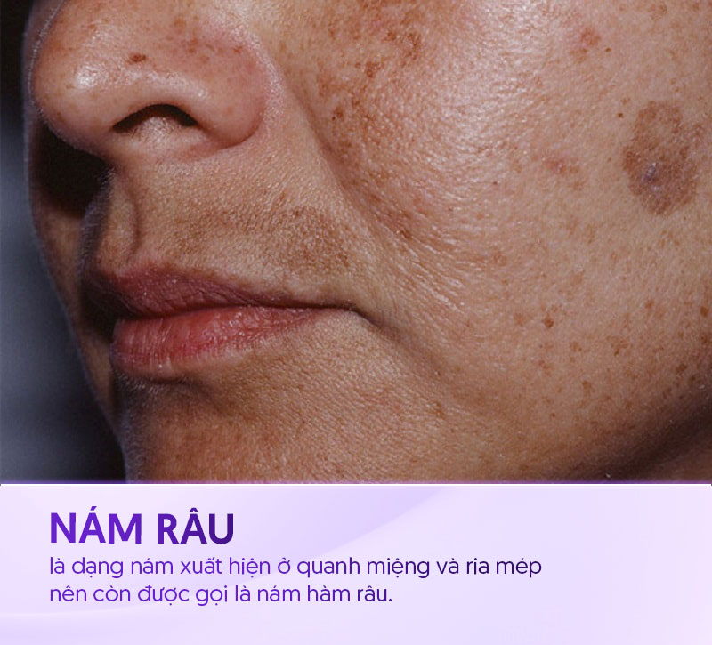 nguy cơ bị nám râu