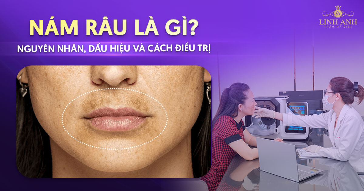 Nám râu là gì? Nguyên nhân, dấu hiệu và cách điều trị