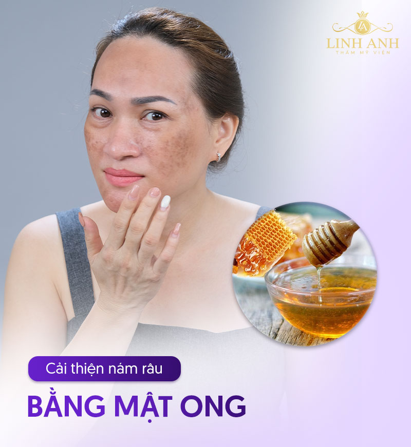 dùng mật ong trị nám