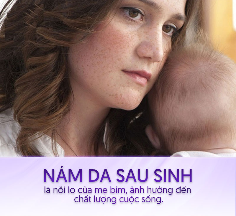 Nám sau sinh là gì