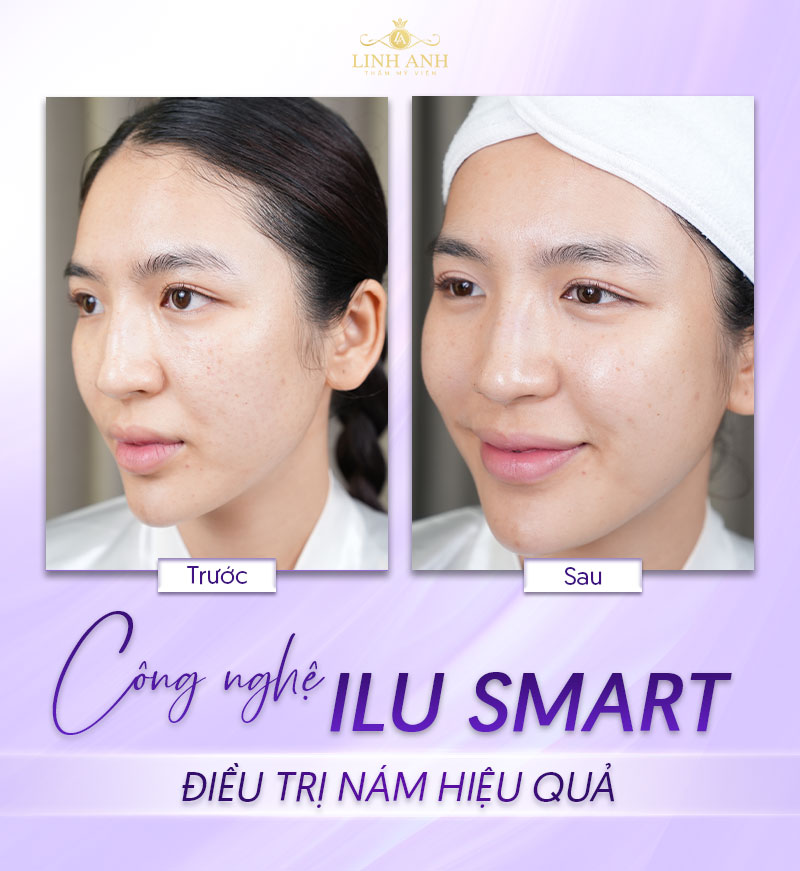 Công nghệ ILU Smart trị nám da sau sinh