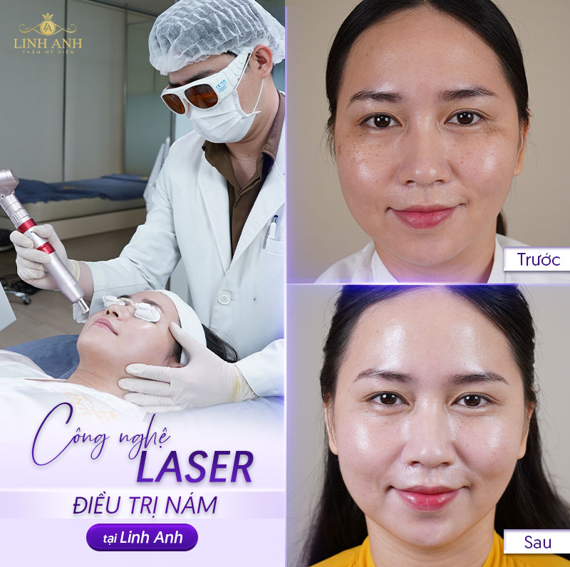 Công nghệ laser trị nám sau sinh