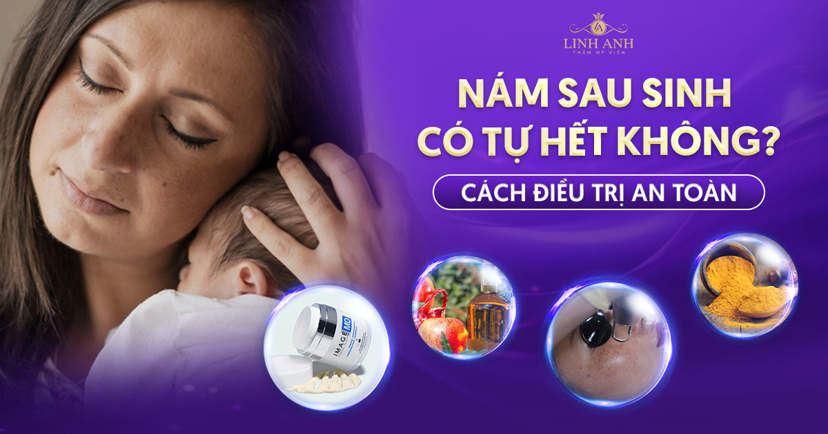 Nám sau sinh có tự hết được không? Cách điều trị an toàn