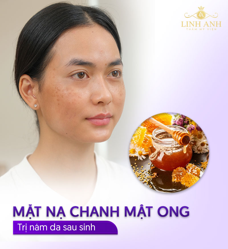 Cách trị nám khi ở cữ bằng chanh mật ong