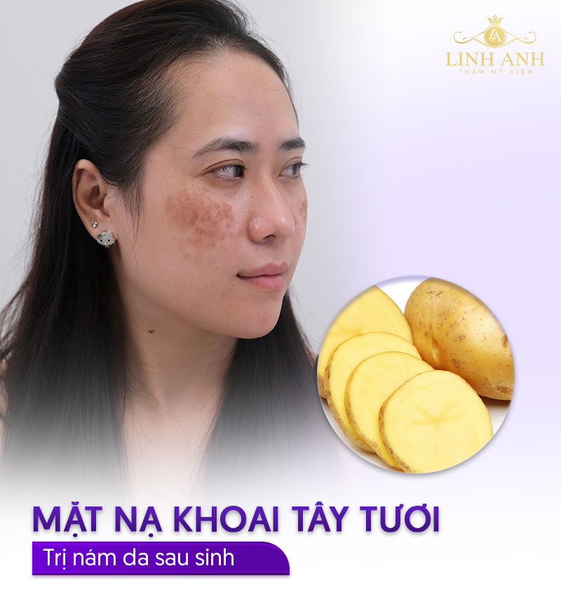 Đắp khoai tây tươi trị nám sau sinh