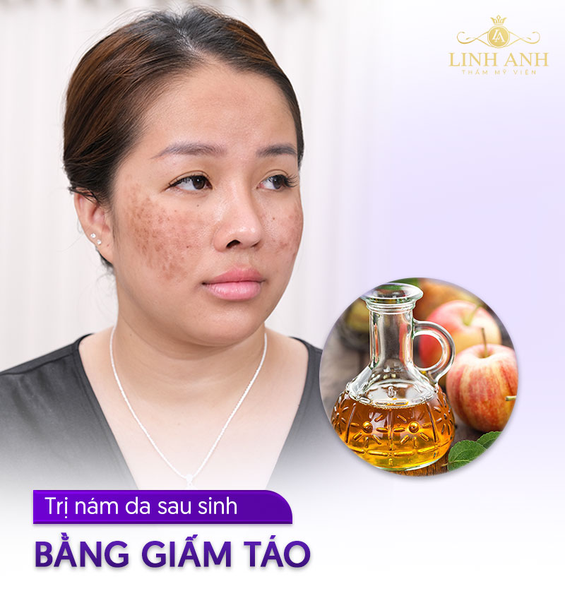 Cách trị nám sau sinh với giấm táo