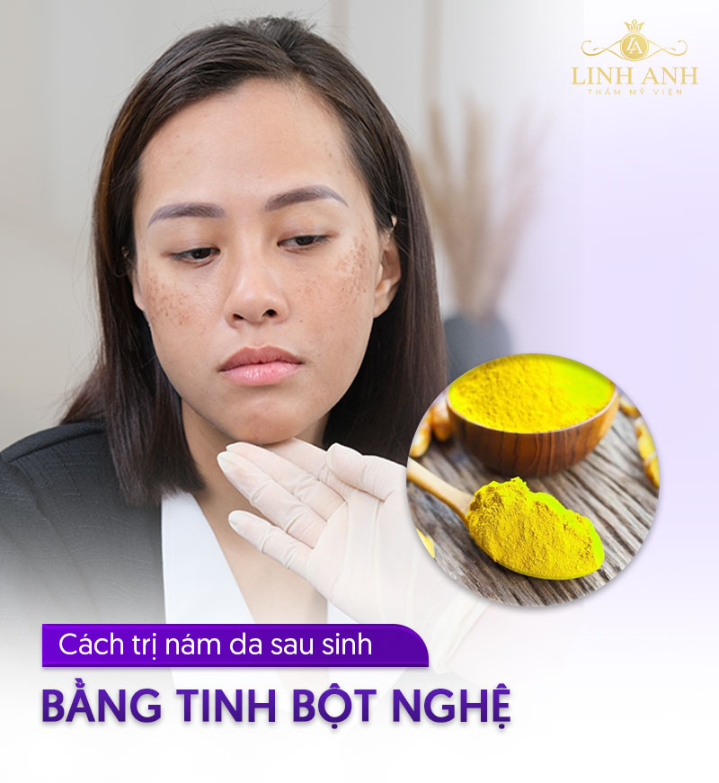 Dùng tinh bột nghệ trị nám da sau sinh