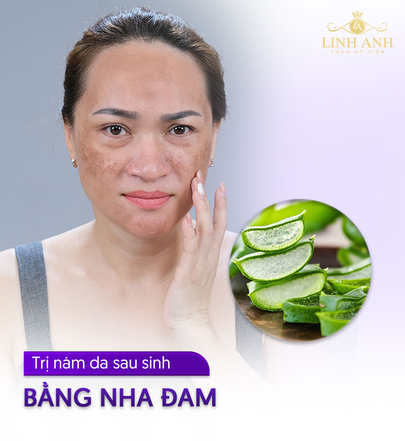 Cách trị nám khi ở cữ với nha đam