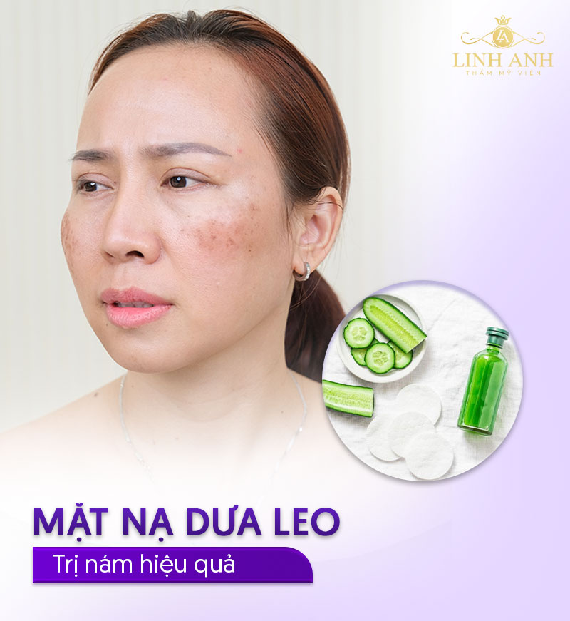 Mặt nạ dưa leo trị nám sau sinh