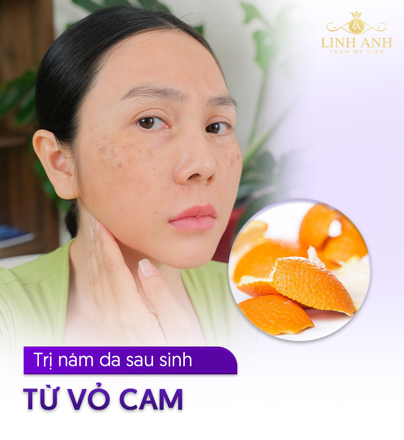 Dùng vỏ cam trị nám sau sinh