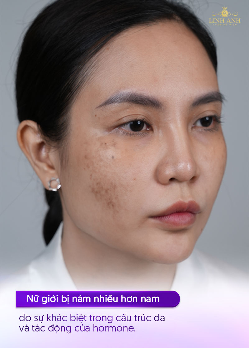 nguyên nhân gây nám tàn nhang ở phụ nữ