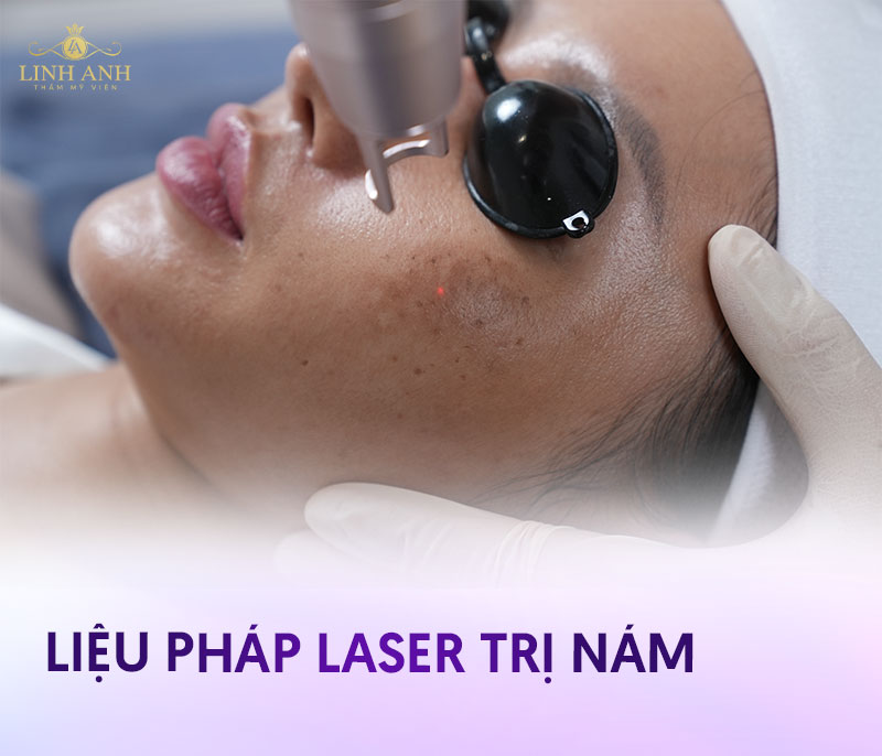 trị nám bằng công nghệ laser