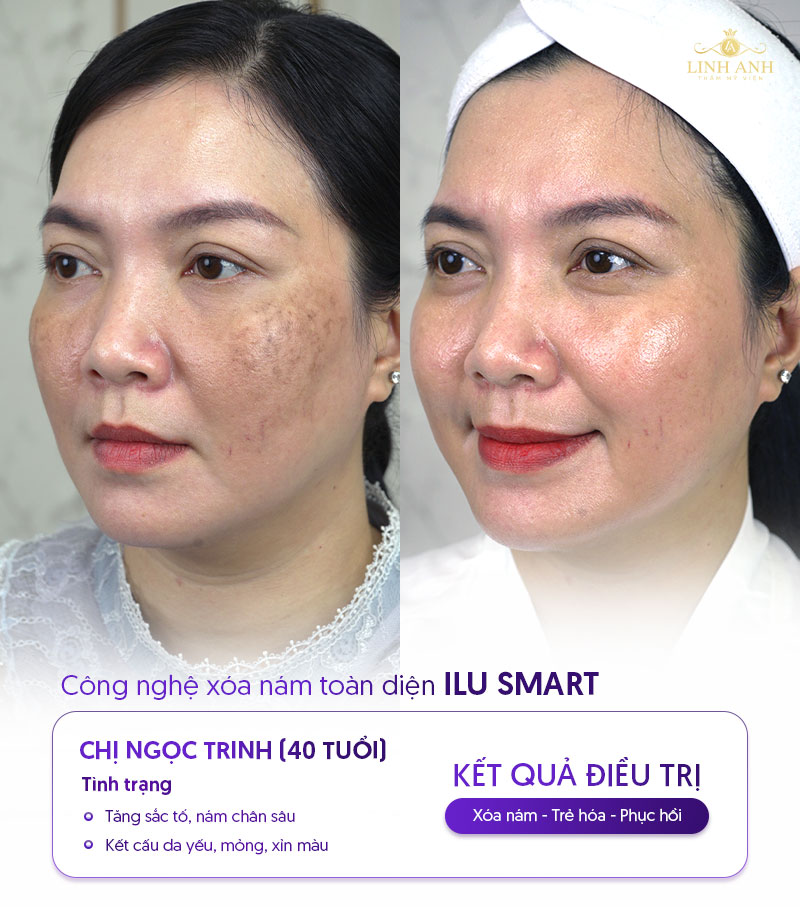 kết quả điều trị nám tàn nhang
