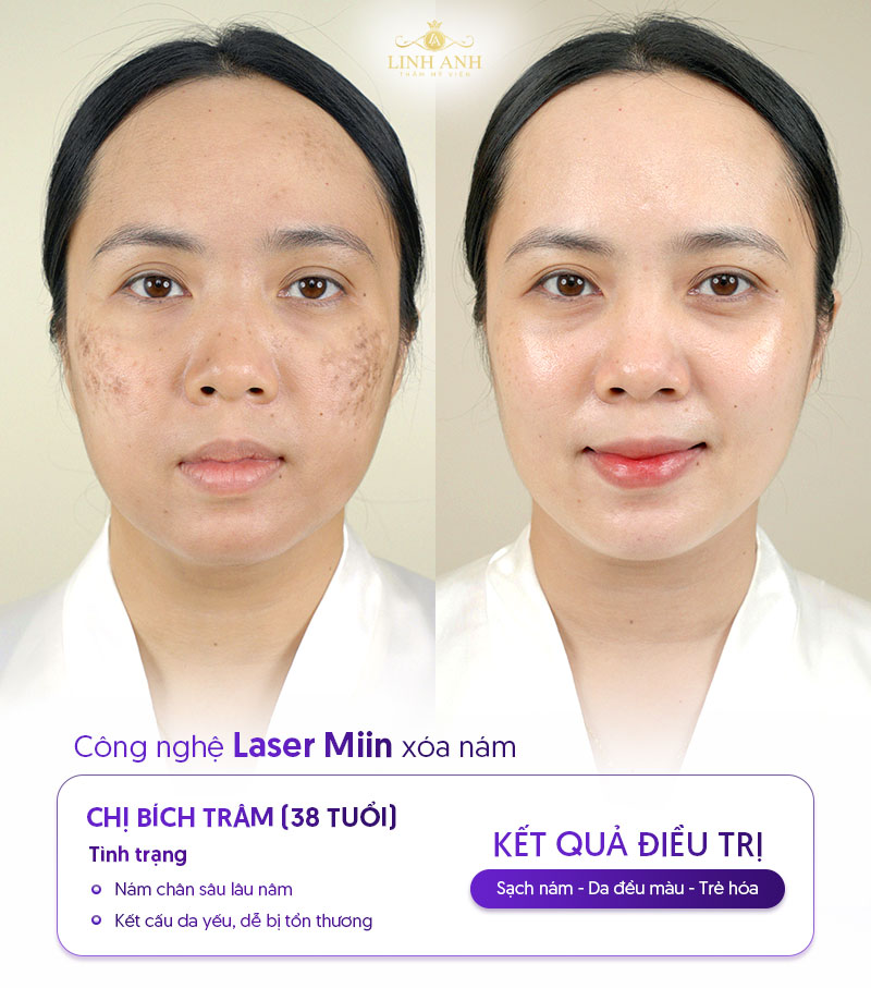 trị nám tàn nhang bằng công nghệ laser miin