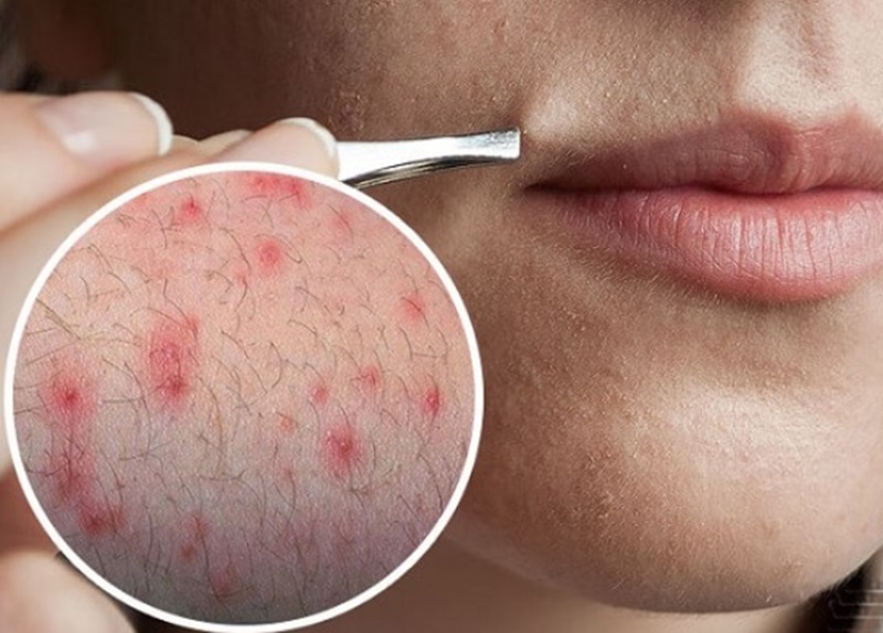 nhổ râu bằng nhíp có sao không nhổ râu bằng nhíp có sao không