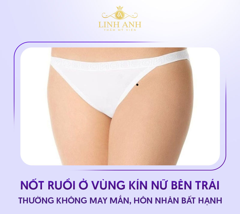 Nốt ruồi ở vùng kín nữ bên trái Nốt ruồi ở vùng kín nữ bên trái