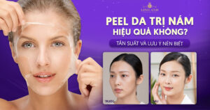 peel da trị nám