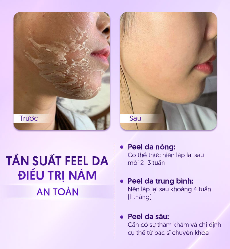 peel da có hết nám không