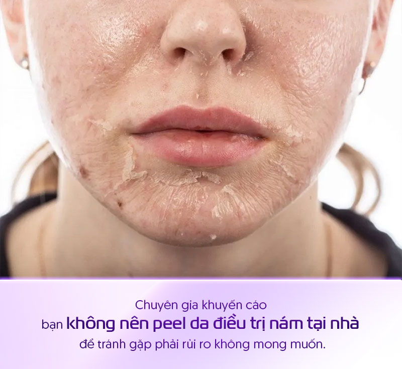 nên hay không nên peel da tại nhà