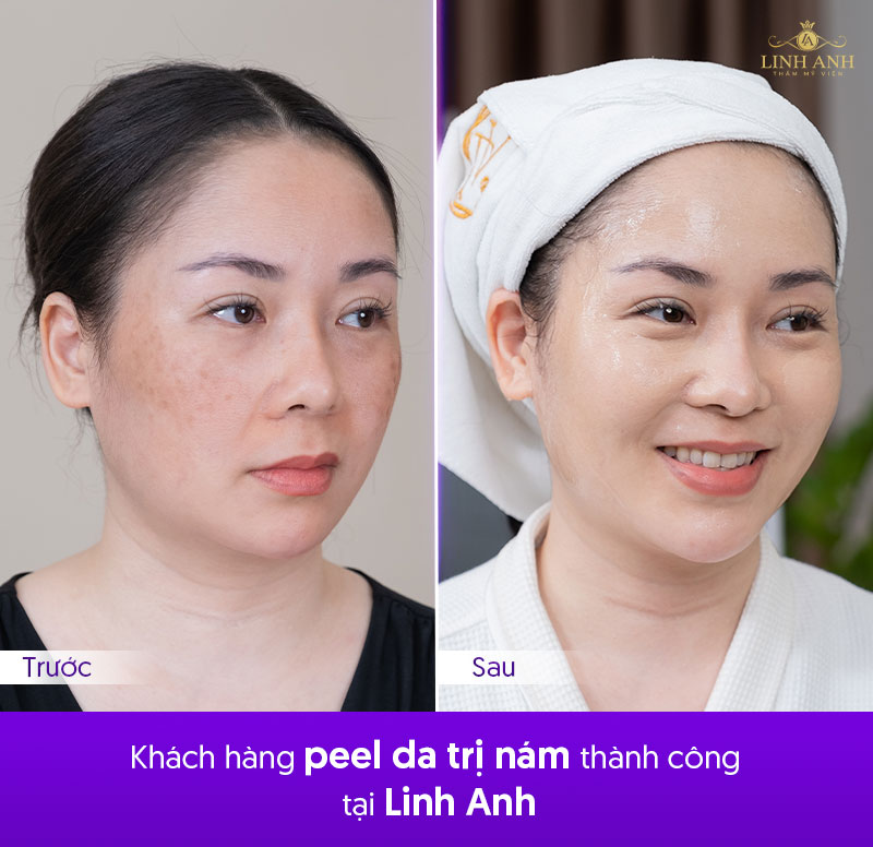 khách hàng điều trị nám thành công