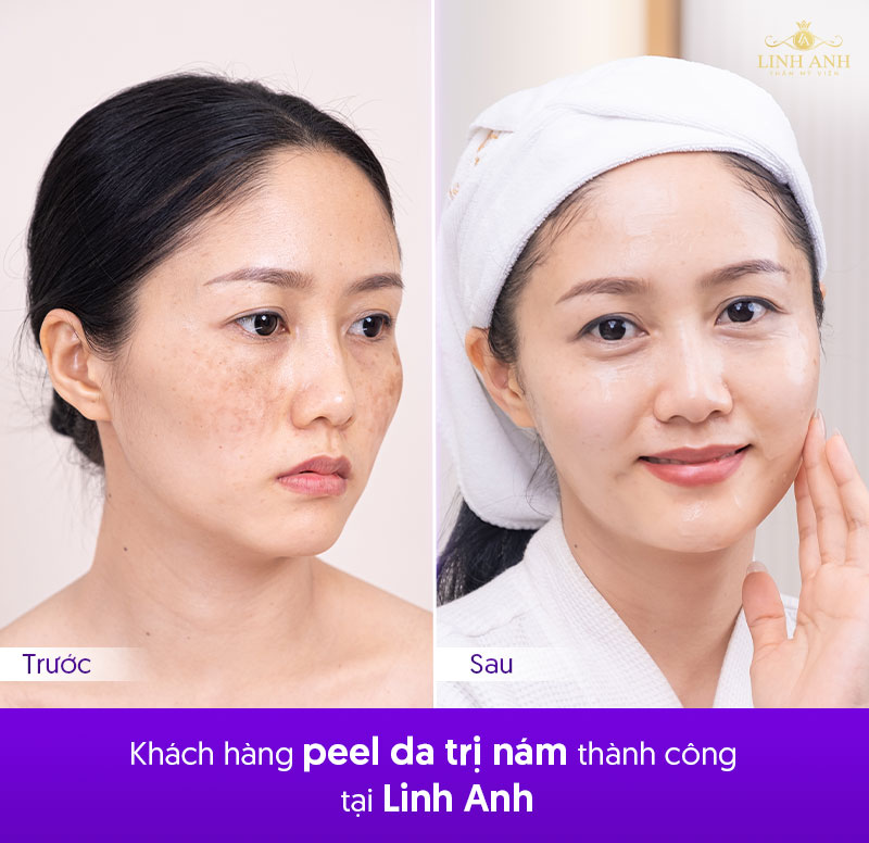 khách hàng peel da trị nám thành công