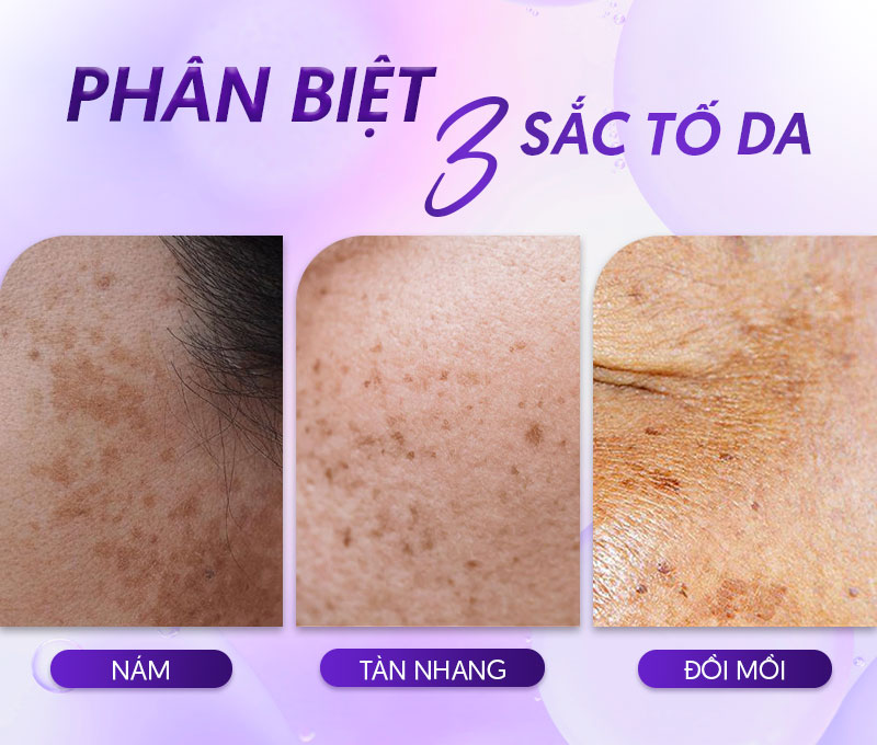 Phân biệt nám tàn nhang và đồi mồi