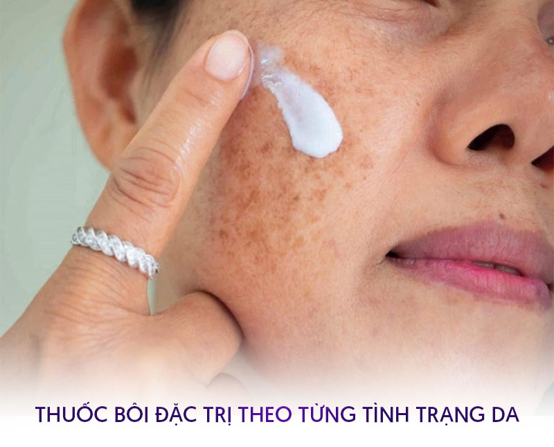 Cách trị tàn nhang đồi mồi trên mặt bằng thuốc bôi